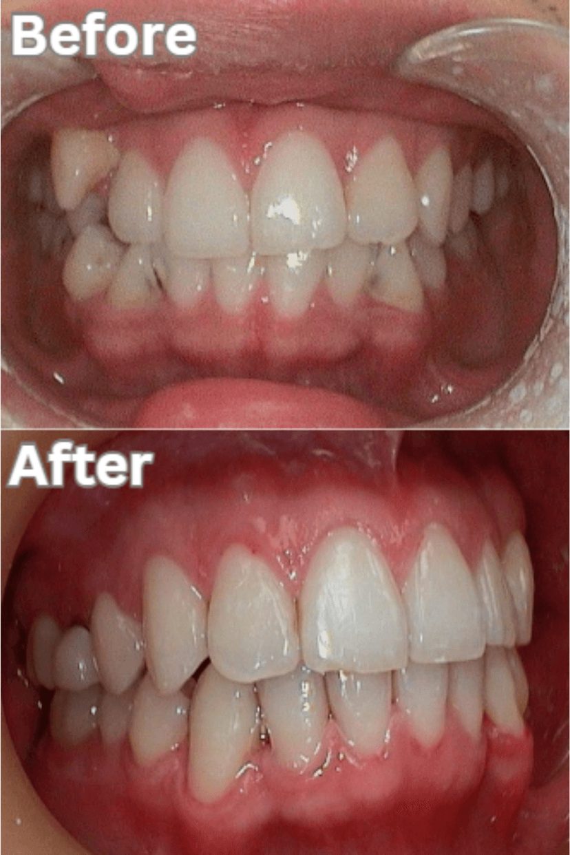 Before and After 1