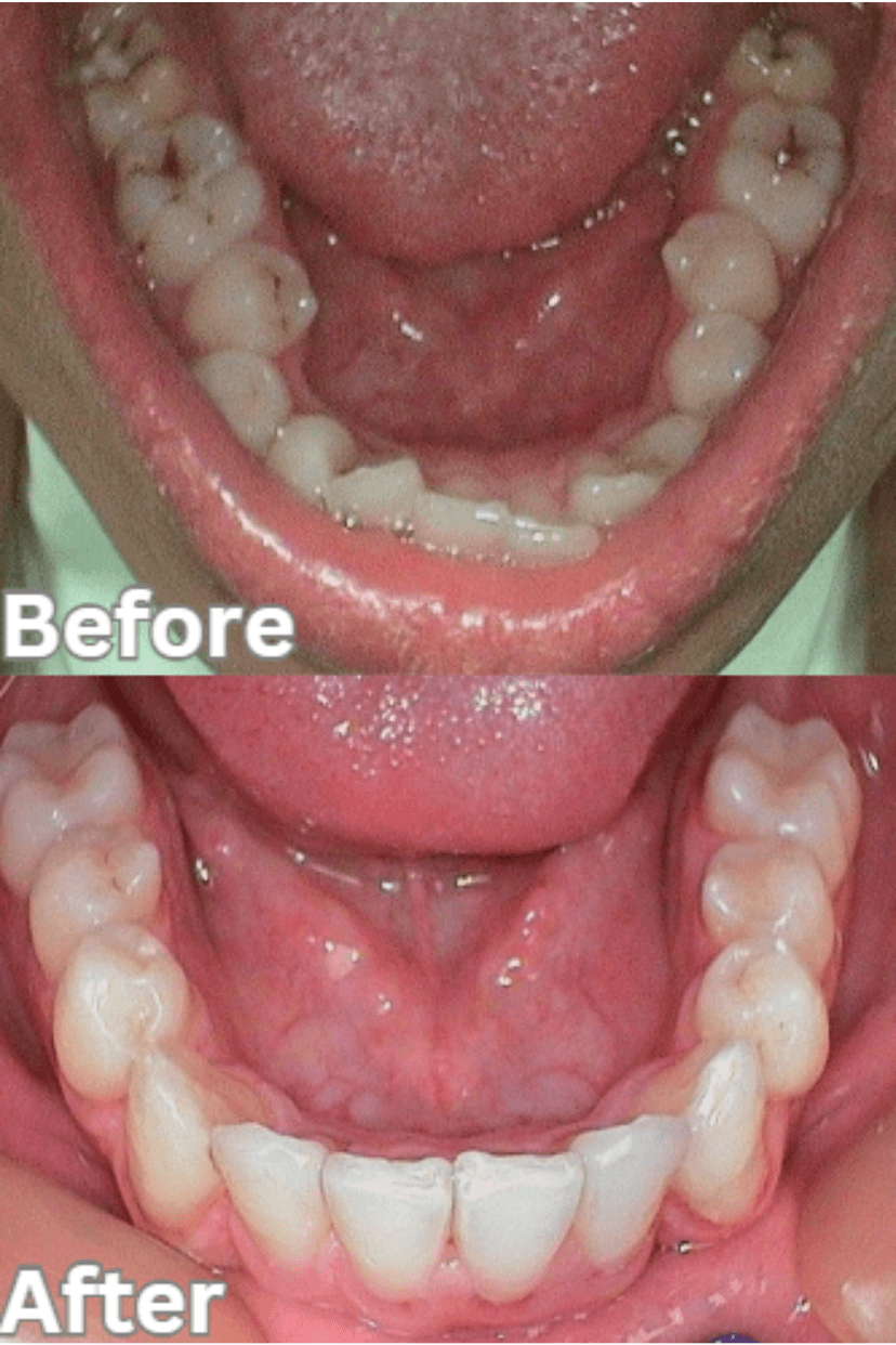 Before and After 2