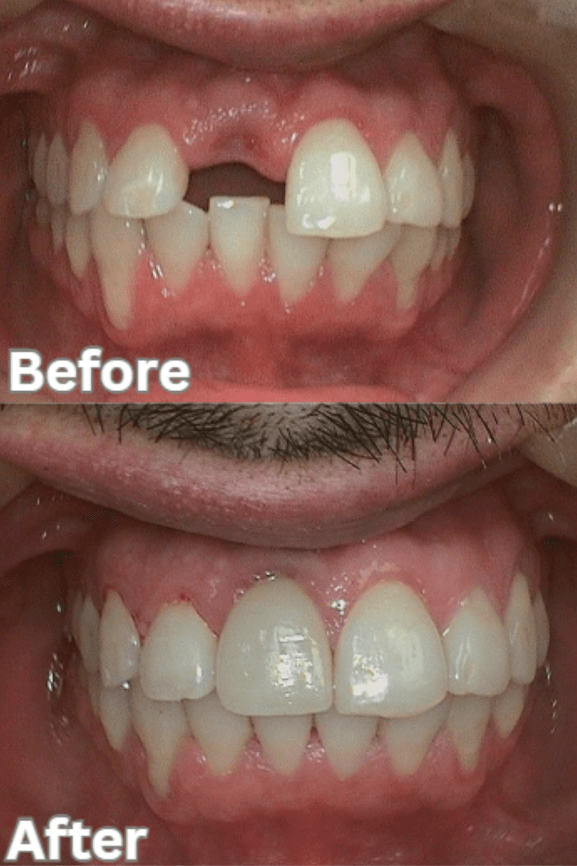 Before and After 3