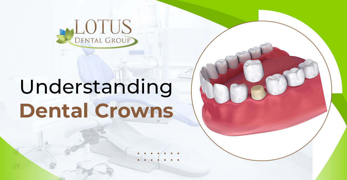 Understanding Dental Crowns: What You Need to Know